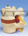 2 Lumbar Vertebrae with prolapsed disc, flexibly mounted